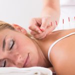 acupuncture therapy on customer’s back at salon