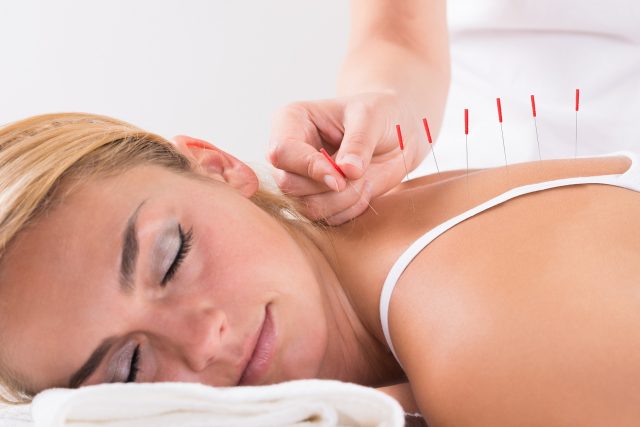 needles acupuncture therapy on customer's back at salon